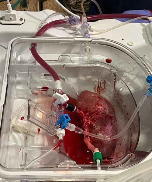 Primer trasplante de riñones modificados con organoides renales humanos en cerdos